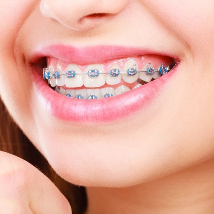 Metal Braces